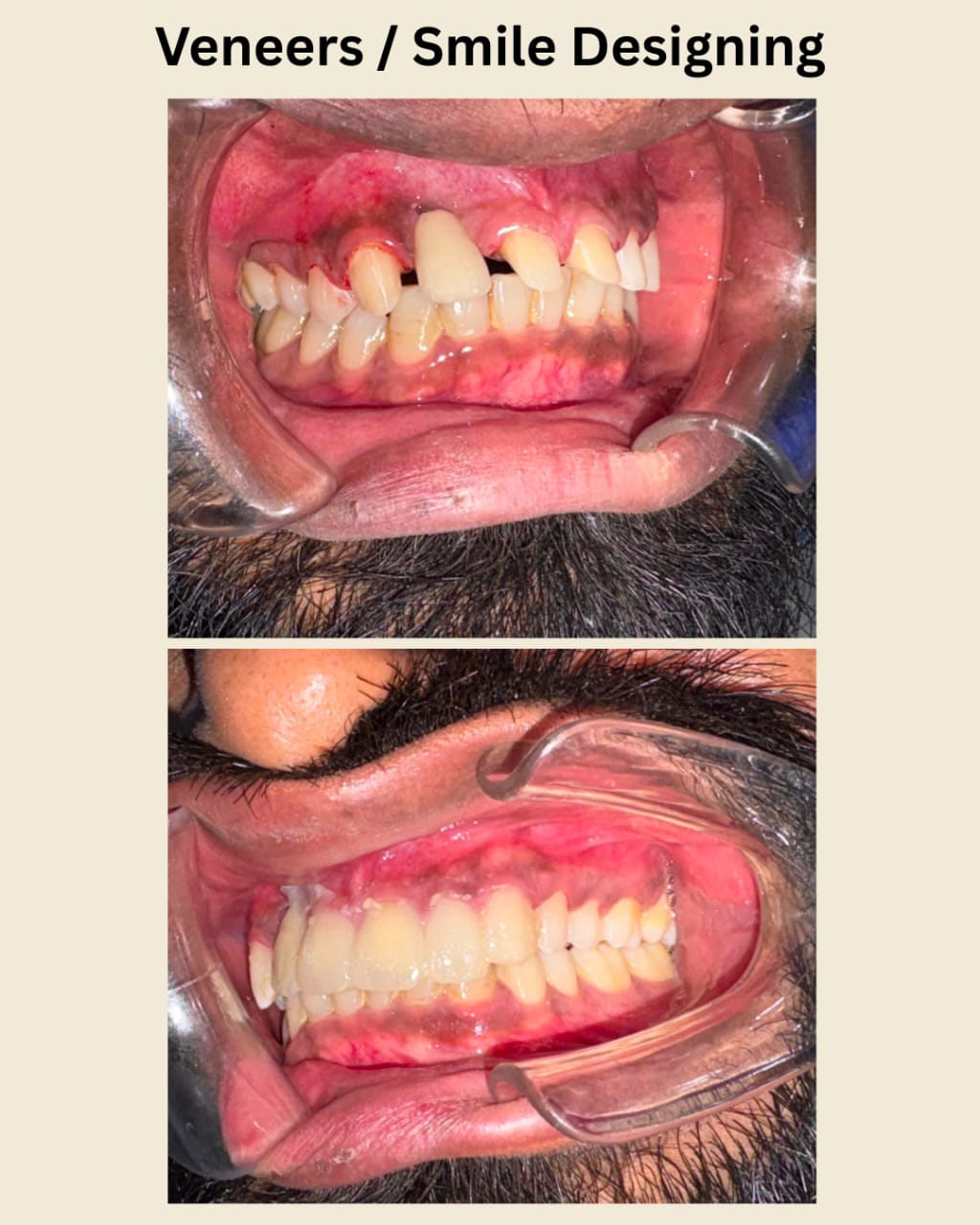 Patient smile at Indu Dental Clinics
